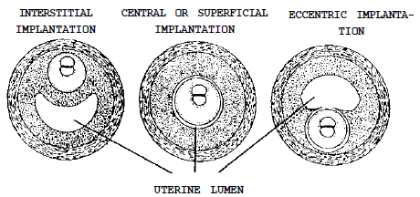 Fig: Types of implanatation