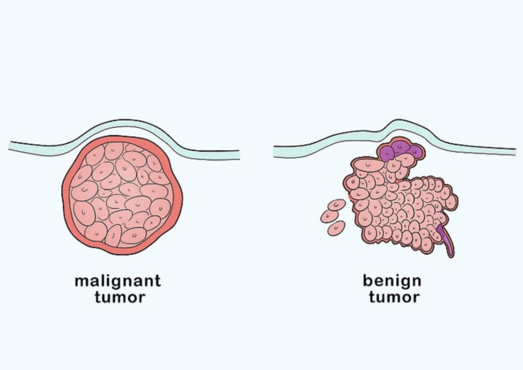Доброкачественная опухоль рисунок